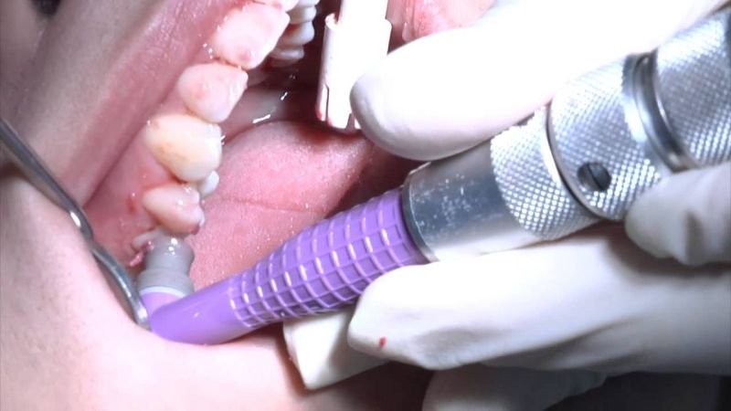 Egy fogorvos bojkottot hirdetett a hálapénz-mutyit eltűrő orvosi kamara ellen