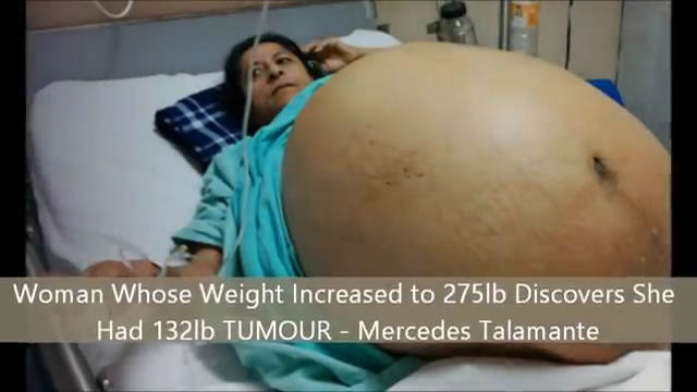 60 kilós daganatot távolítottak el egy asszony testéből