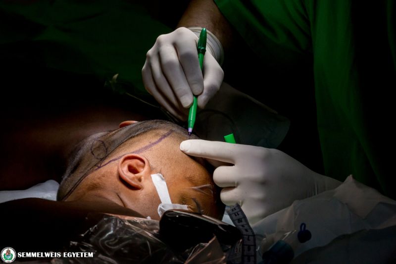 Fotó: sikeres műtétet hajtottak végre a fejüknél összenőtt sziámi ikreken Budapesten