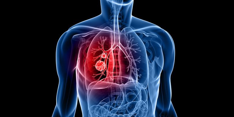 Javult a tüdődaganatos betegek túlélési aránya Magyarországon