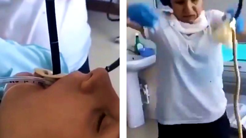 Félelmetes: 1,2 méteres kígyót szedtek ki a nő torkából az orvosok – VIDEÓ is készült róla