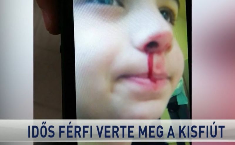 Idős férfi törte be az orrát egy 11 éves gyereknek Pécsen